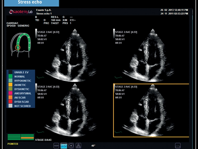 MyLab™X7 - Stress echo