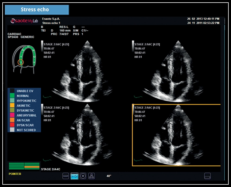 MyLab™X7 - Stress echo