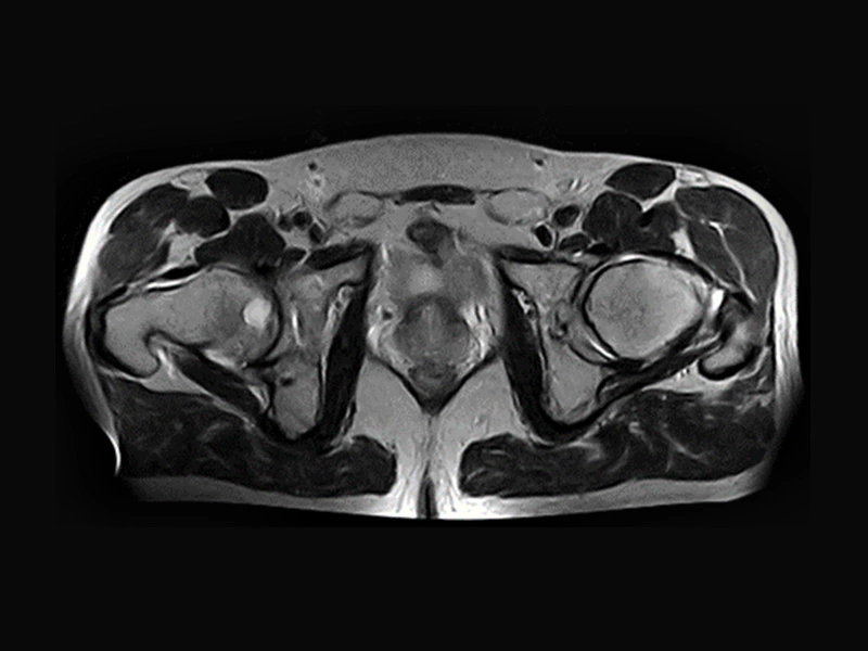 Magnifico™Open - Hip SE T2 axial