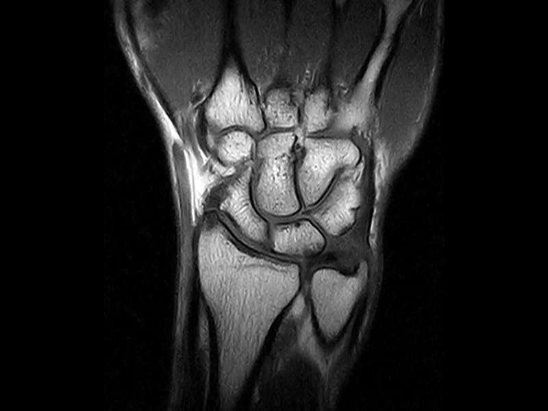 Magnifico™Open - Wrist FSE T2 coronal