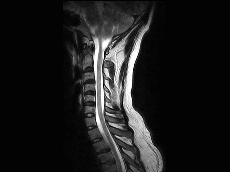 Magnifico™Open - Cspine FSE T2 sagittal