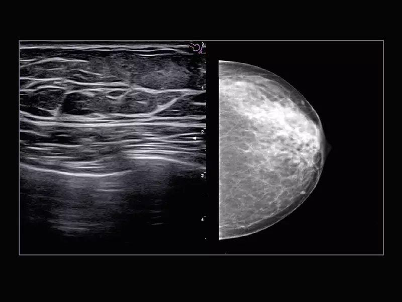 MyLab™X9 - Breast 02