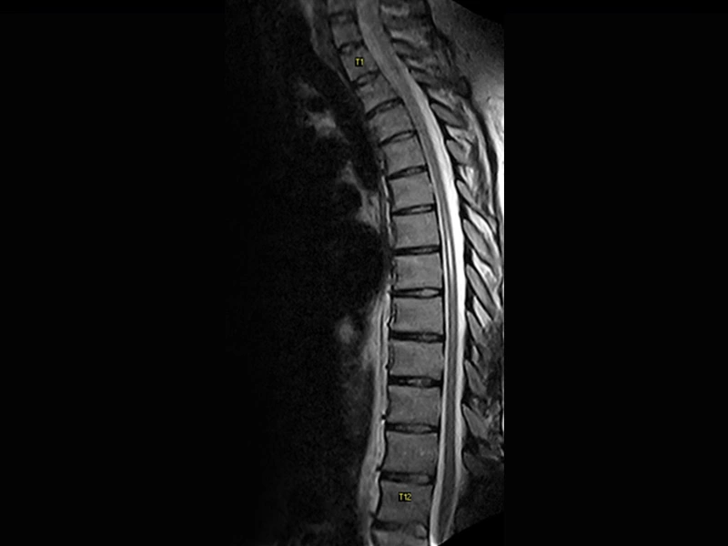 Magnifico™Open - Dspine FSE T2 sagittal