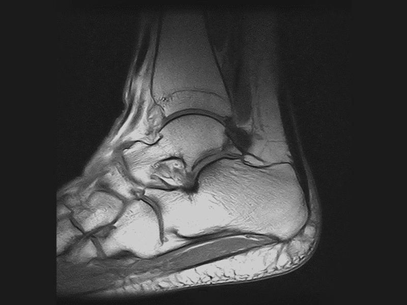 Magnifico™Open - Ankle SE T1 sagittal