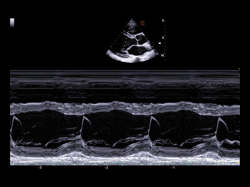 MyLab™A50 - Heart Mmode