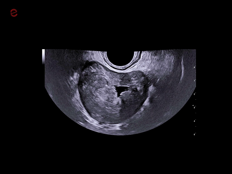 MyLab™C30 - Prostate median plan axial view TLC 3-13