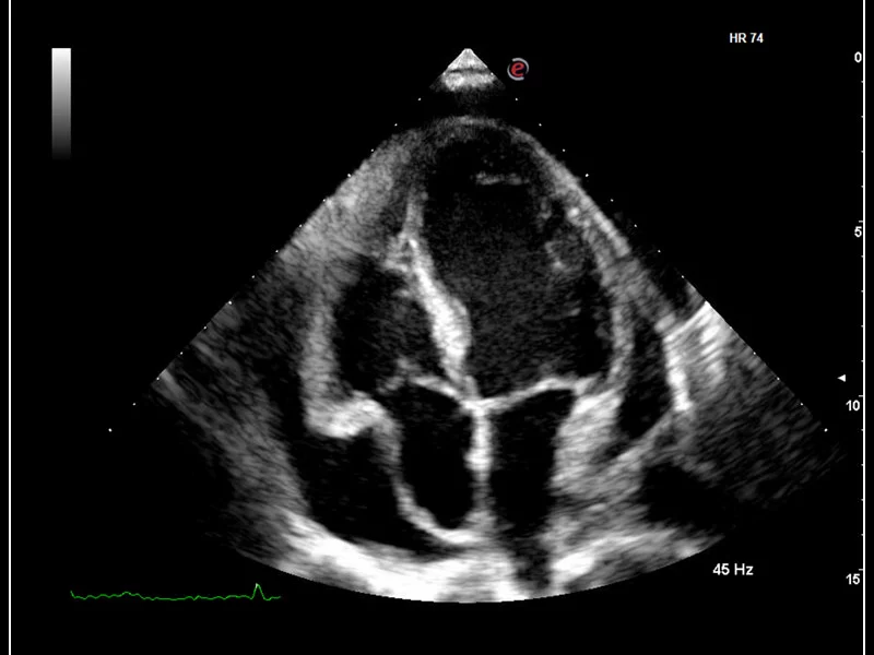 MyLab™9 Platform - XView real-time algorithm reducing speckle noise artefact in pathologies analysis quantification