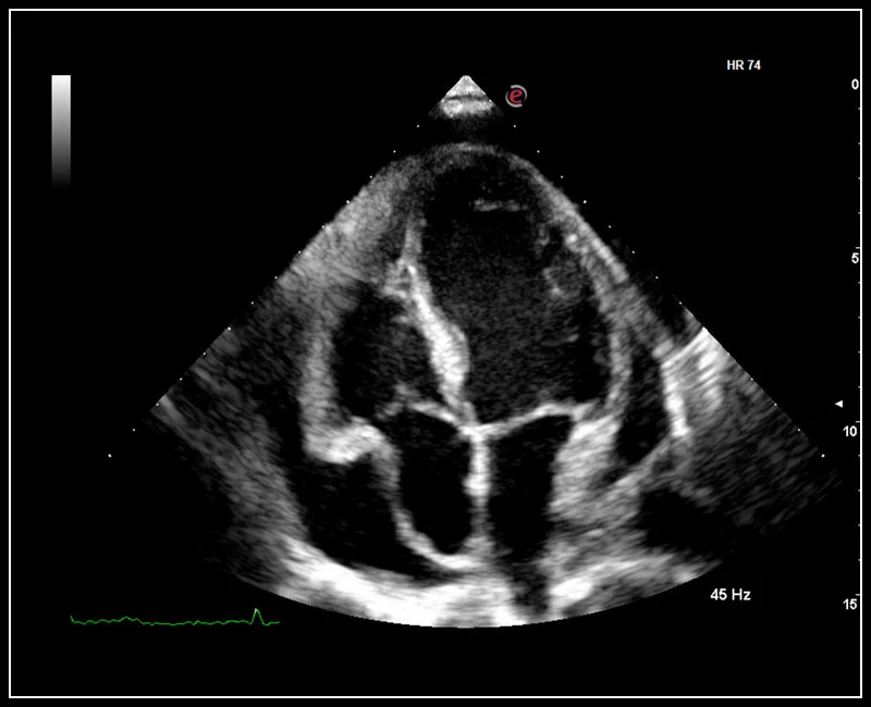 MyLab™9 Platform - XView real-time algorithm reducing speckle noise artefact in pathologies analysis quantification
