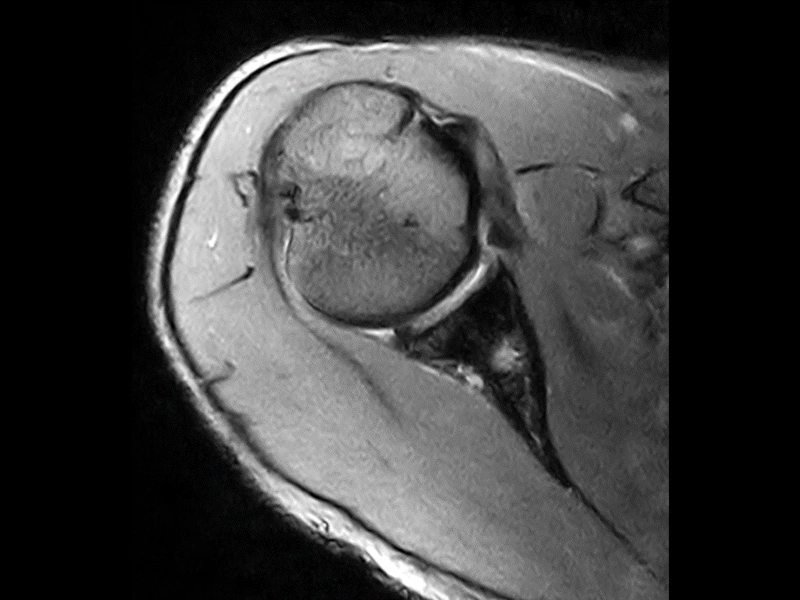 Magnifico™Open - Shoulder GE T2 star axial