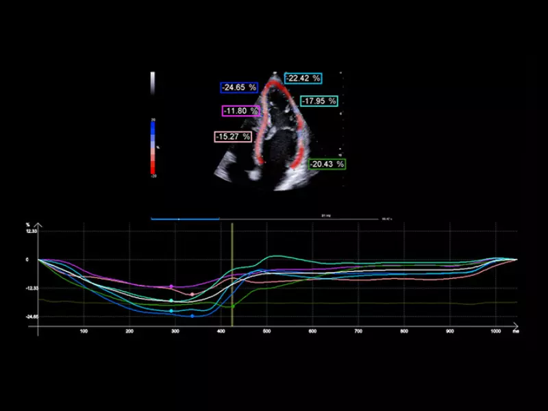MyLab™X90 - XStrain™ LV Automatic assessment of global longitudinal strain in the left ventricle