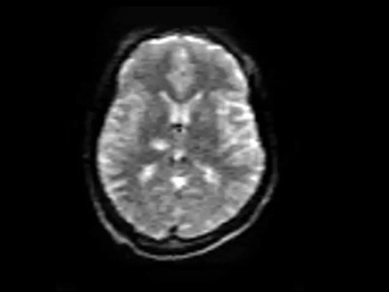 Magnifico™Open - DWI 2