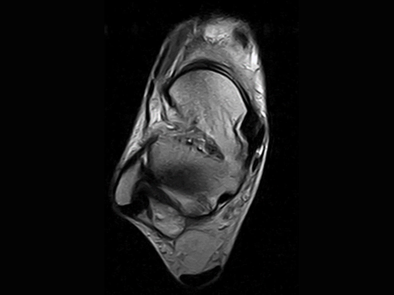 Magnifico™Open - Ankle FSE T2 axial