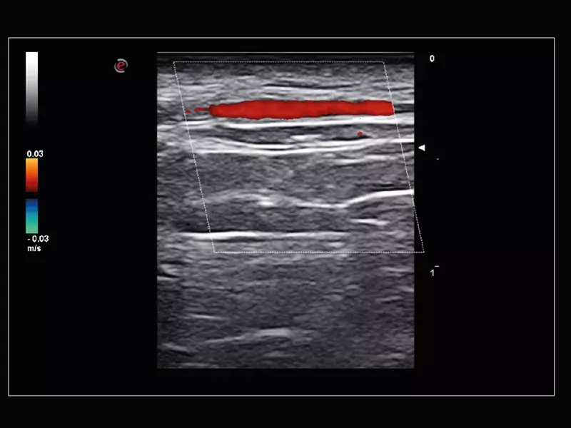 MyLab™Sigma Elite - Temporal Artery exploration with Very High Frequency probe (22 MHz)