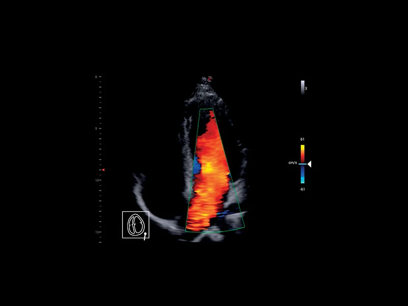 MyLab™X1 - Apical view CFM