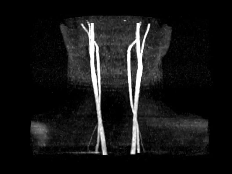 Magnifico™Open - 2D TOF Carotid frontal