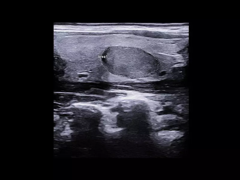 MyLab™X90 - eDetect Automatic contouring of thyroid and breast lesions in suspicious areas suggested (ROI) by the physicians