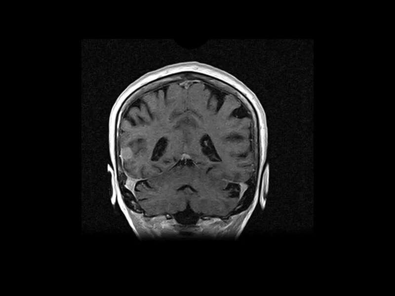 S-scan Open - 3D SST1 Head