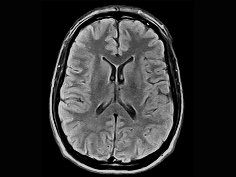 Magnifico™Open - Brain FLAIR axial