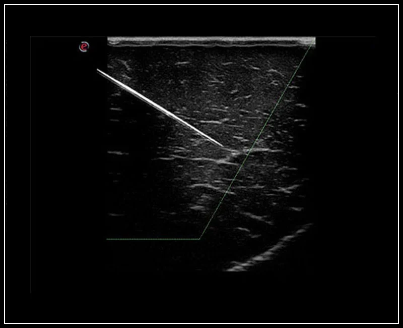 MyLab™Omega - Optima needle tip visualization using Needle Enhancement