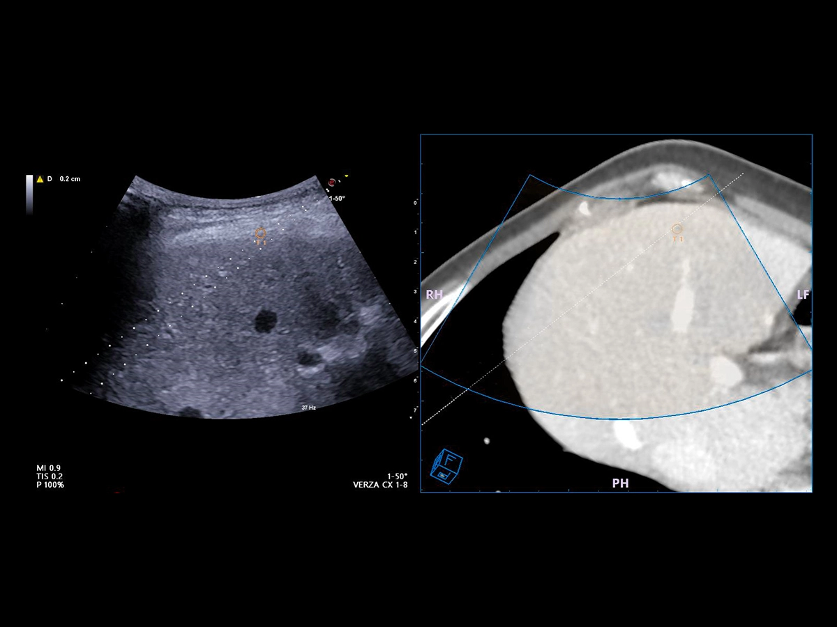 Liver Interventional procedures