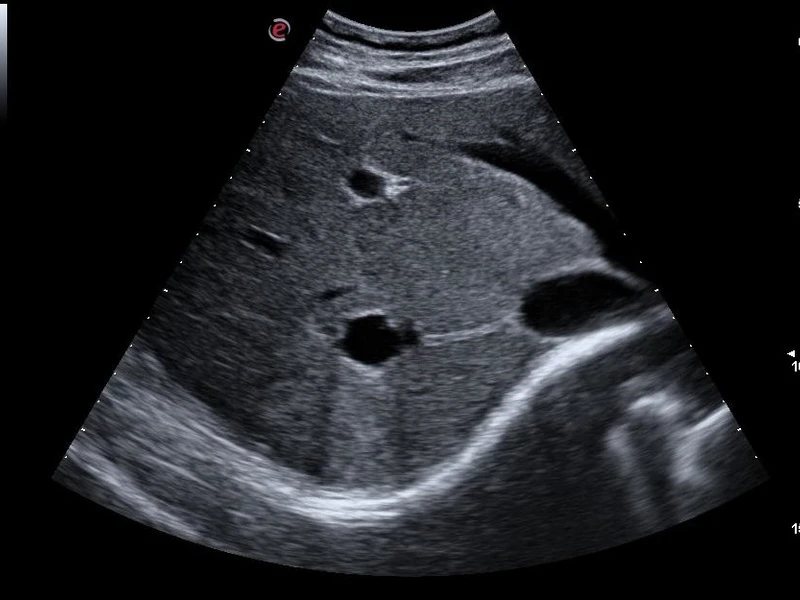 MyLab™Omega - CPI and XView liver cyst visualization