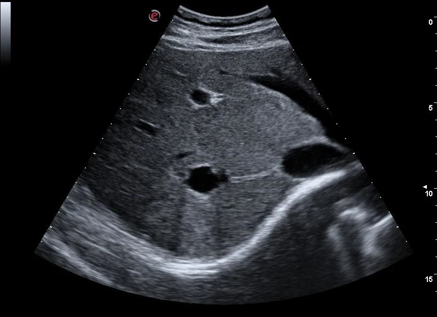 MyLab™Omega - CPI and XView liver cyst visualization
