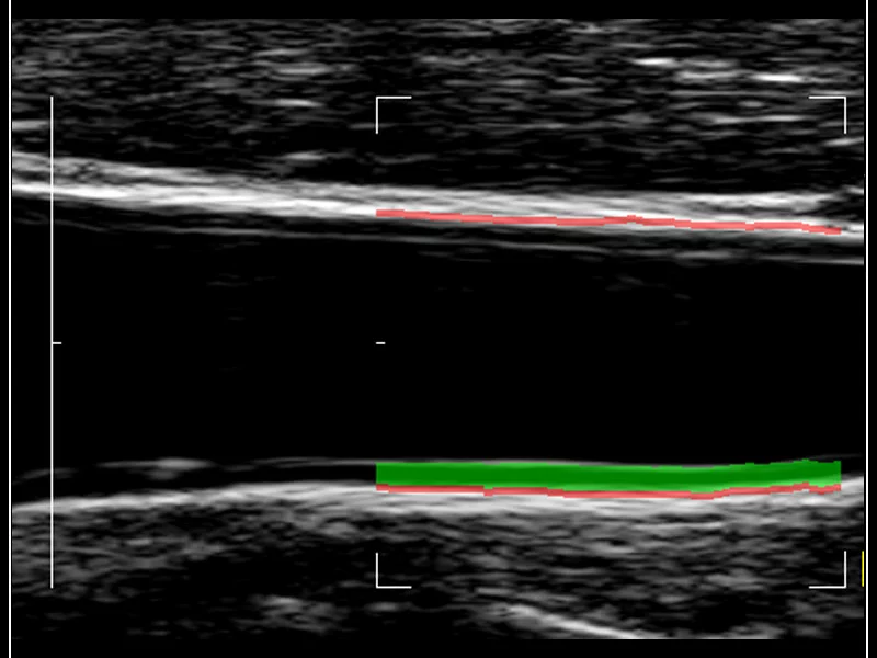 MyLab™9 Platform - QIMT Intima-media thickness quantification based on radio frequencies in real-time studies