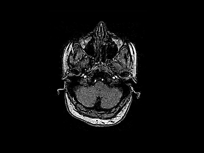 Magnifico™Open - MIP