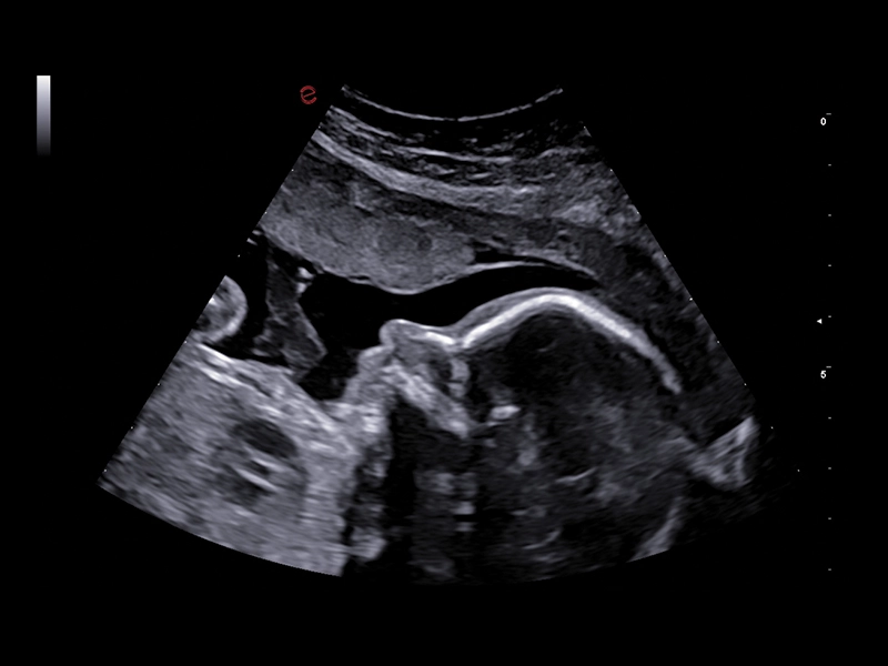 MyLab™A70 - Baby face