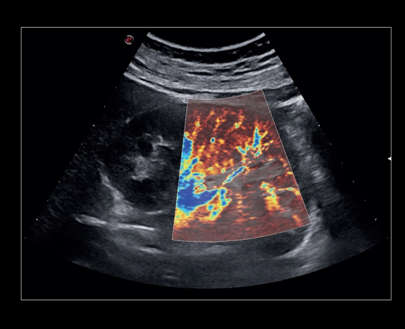 MyLab™X8 Platform - Tissue perfusion visualisation with microV