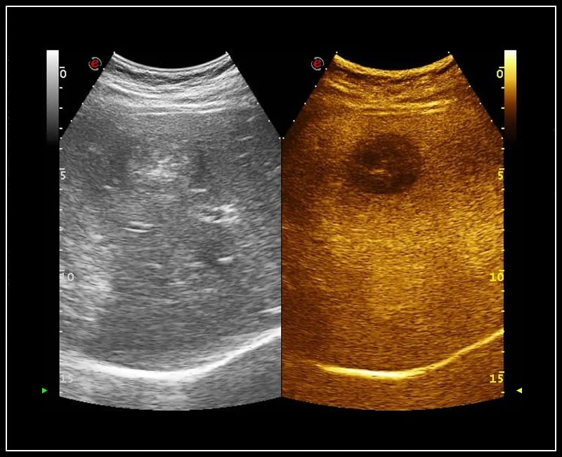 MyLab™Omega - Liver metastasis using CnTI™