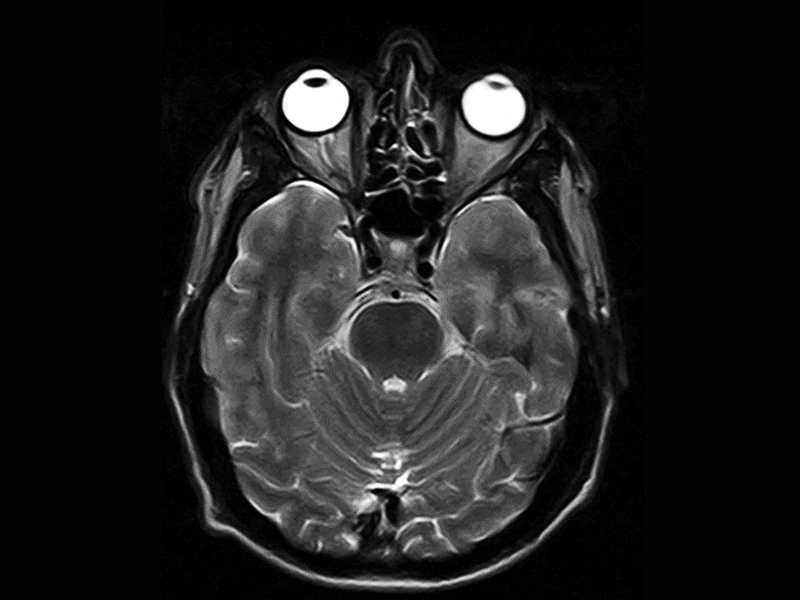 Magnifico™Open - Brain FSE T2 axial