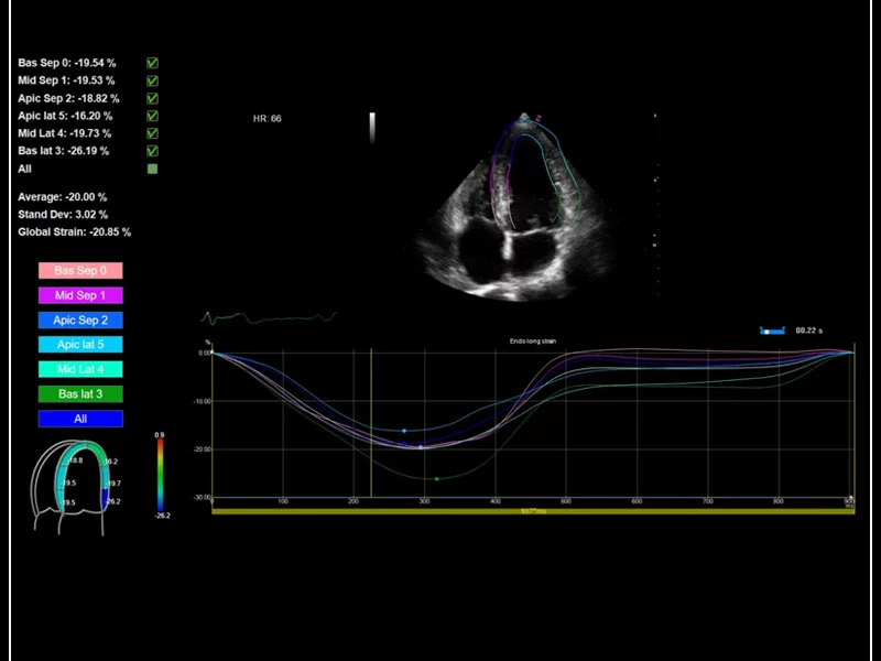 MyLab™9 Platform - XStrain™ 2D speckle tracking technologies for global and regional function