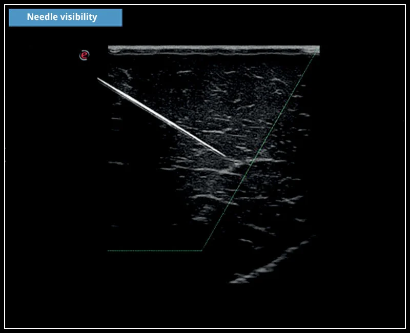 MyLab™X5 - Needle visibility