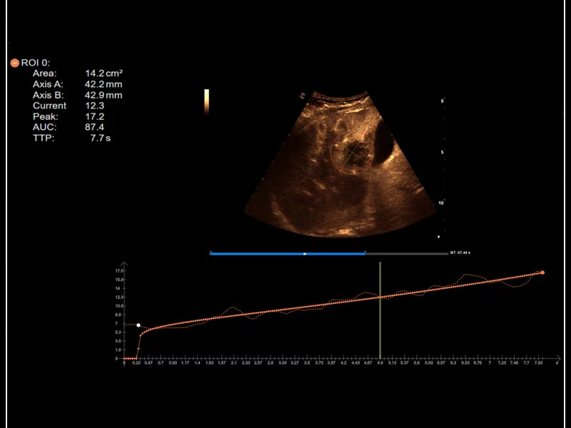 MyLab™9 Platform - QPack CnTI™ perfusion analysis post RF ablation