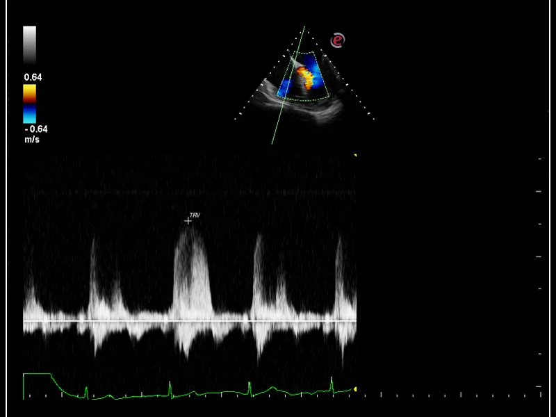 MyLab™Omega - CW Doppler