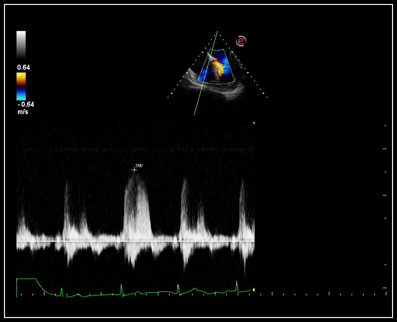 MyLab™Omega - CW Doppler