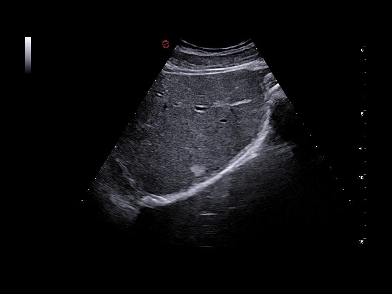 MyLab™A70 - Liver Bmode