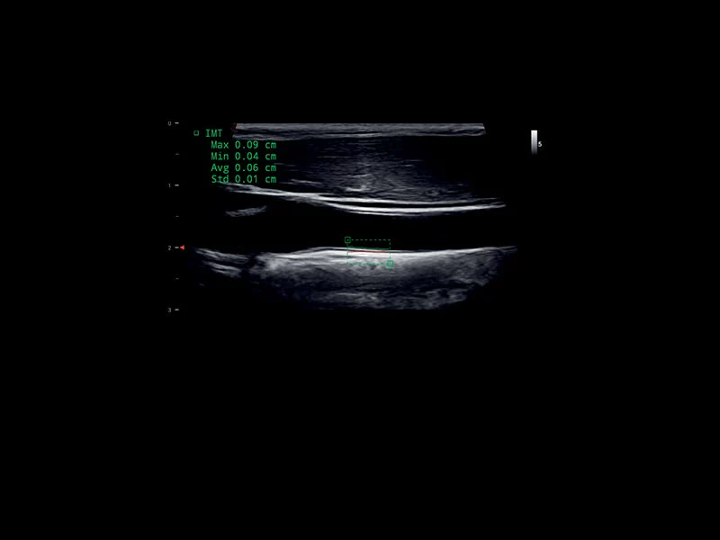 MyLab™X1 - Carotid IMT Calculation