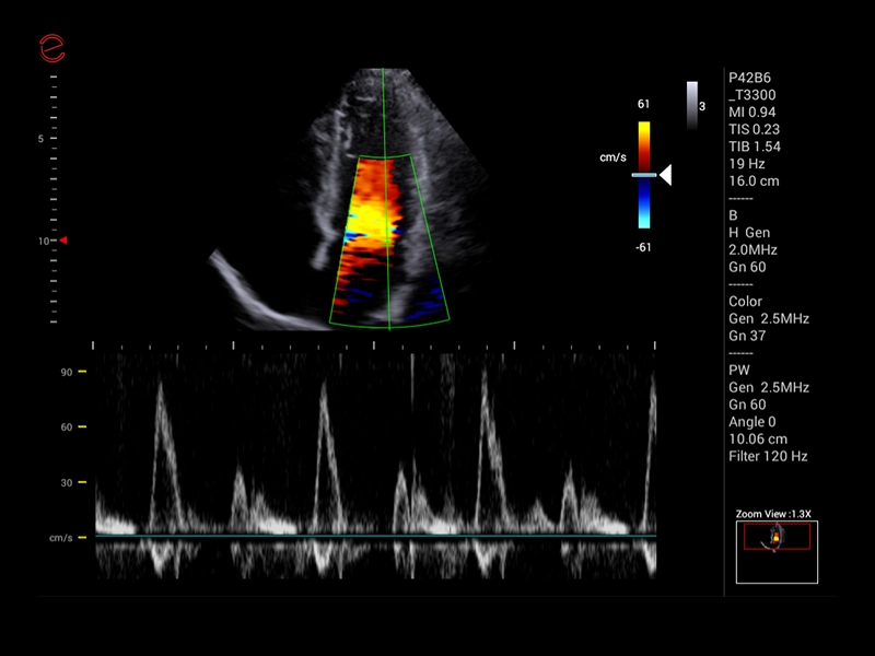 MyLab™X1 Go - CV Doppler 1
