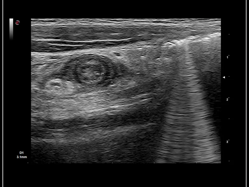 MyLab™9 Platform - Axial view of appendicitis