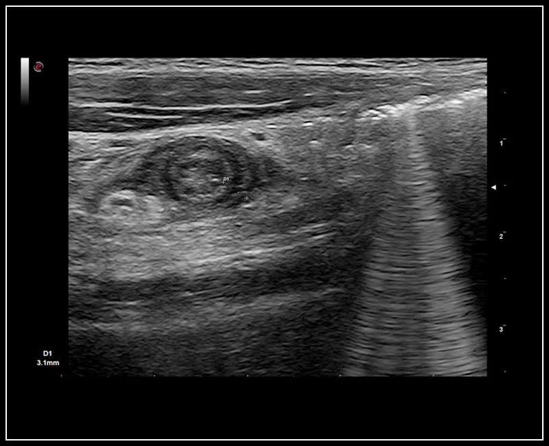MyLab™9 Platform - Axial view of appendicitis