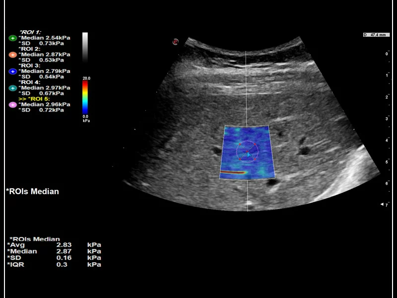 MyLab™9 Platform - QElaXto 2D shearwave elastography in liver