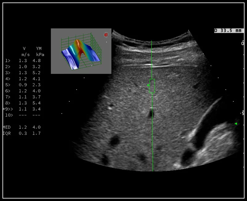 MyLab™9 Platform - QElaXto point Shearwave Elastography in liver