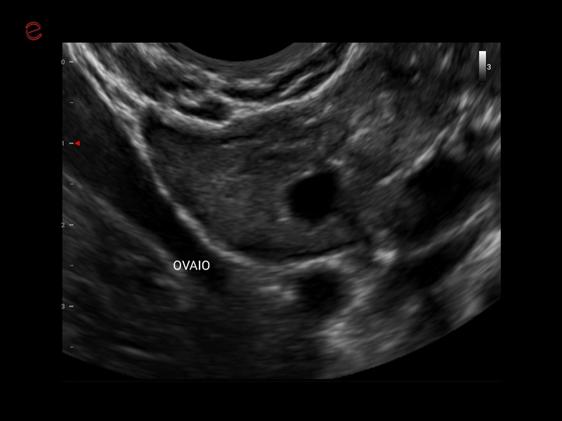 MyLab™X1 Go - WH Ovary