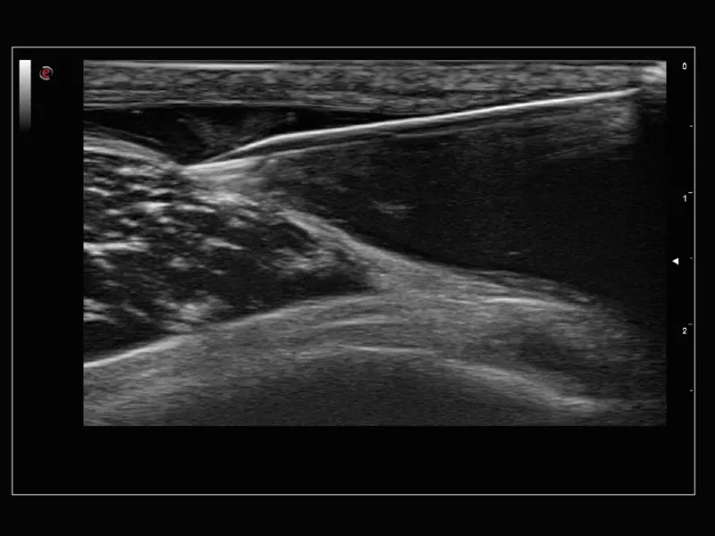 MyLab™Sigma Elite - Needle Enhancement for precise interventional procedures