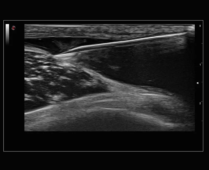 MyLab™Sigma Elite - Needle Enhancement for precise interventional procedures