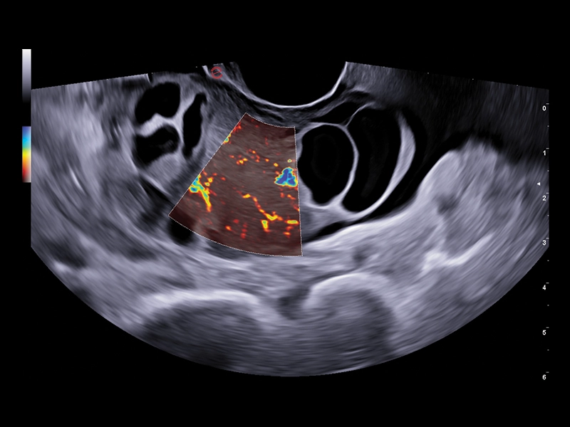 MyLab™A50 - Uterus