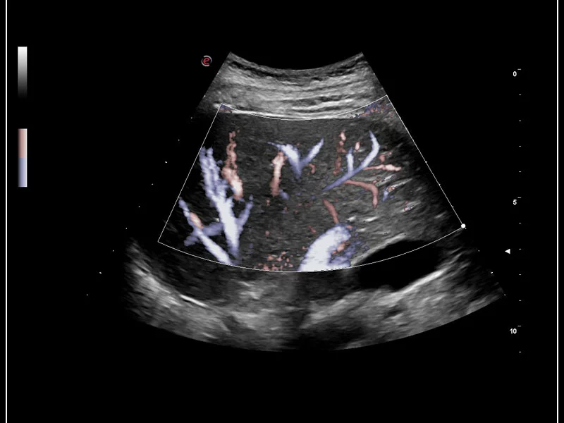 MyLab™9 Platform - XFlow Doppler enhancement in liver vascularization