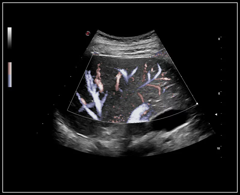 MyLab™9 Platform - XFlow Doppler enhancement in liver vascularization